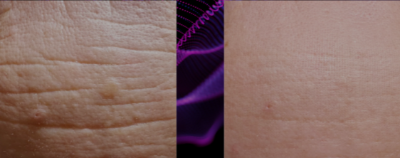 efekt wygładzenia zmarszczek po zastosowaniu lasera tulowego